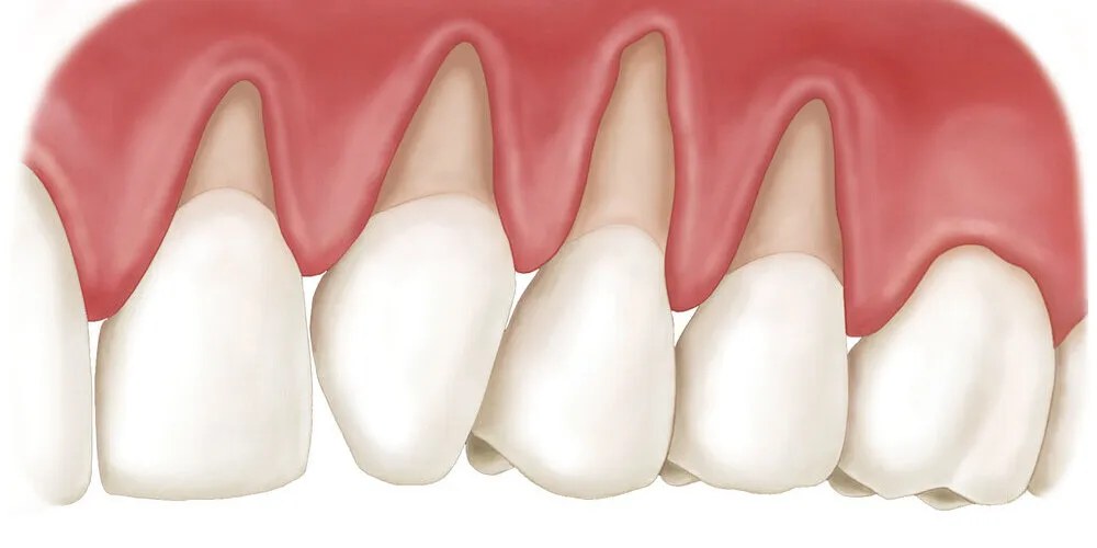 Understanding Gum Recession and How to Protect Your Smile Understanding Gum Recession